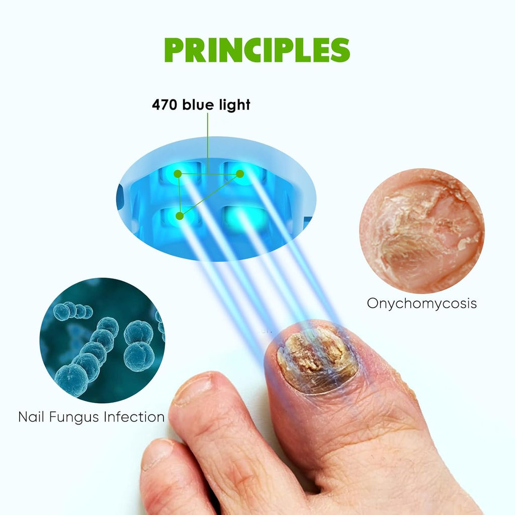 Blue Light for Nail Fungus W694