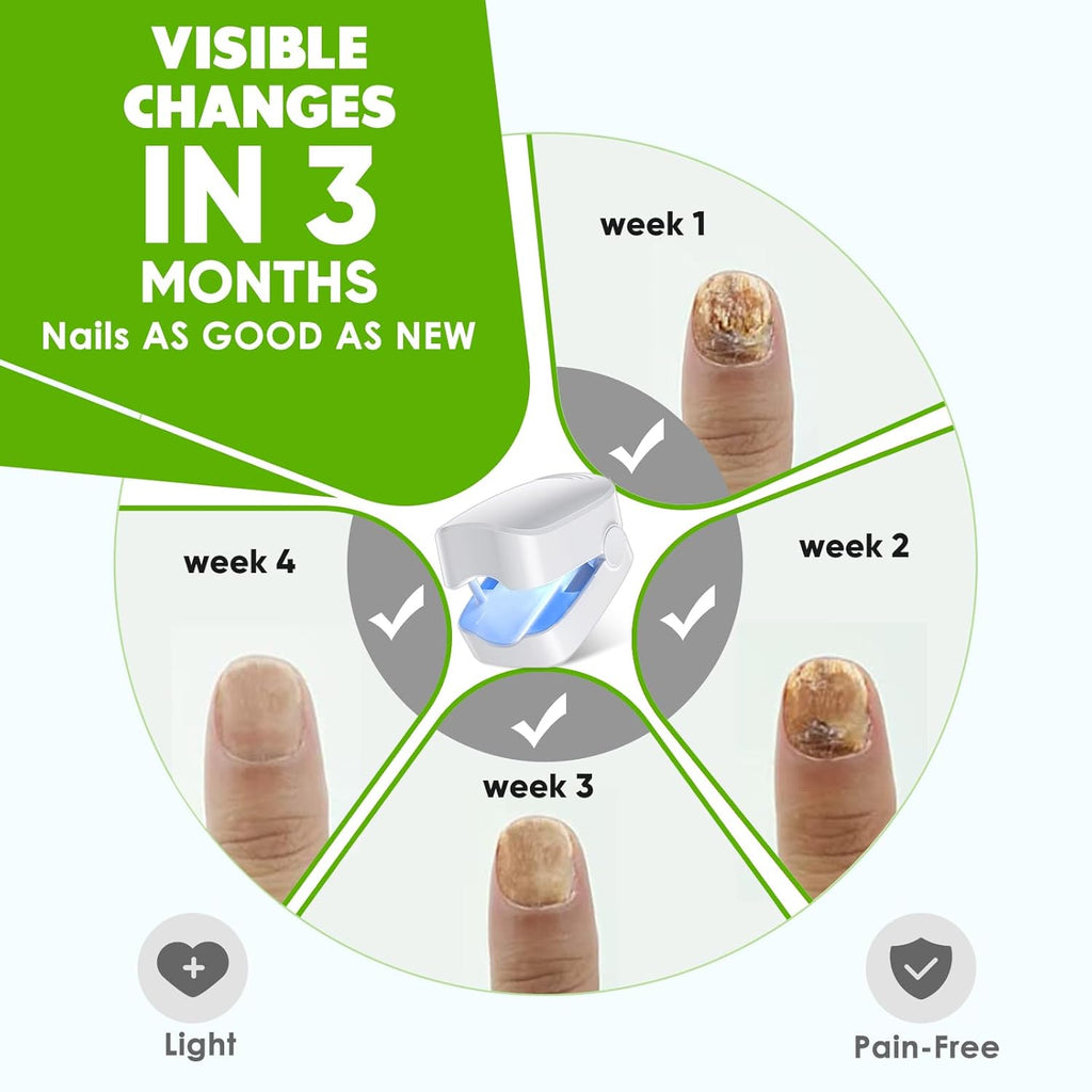 Blue Light for Nail Fungus W694